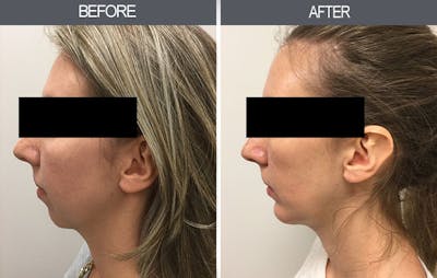 Chin Implants Before & After Gallery - Patient 4452268 - Image 2