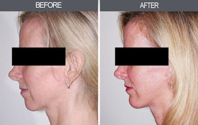 Chin Implants Before & After Gallery - Patient 4452269 - Image 1
