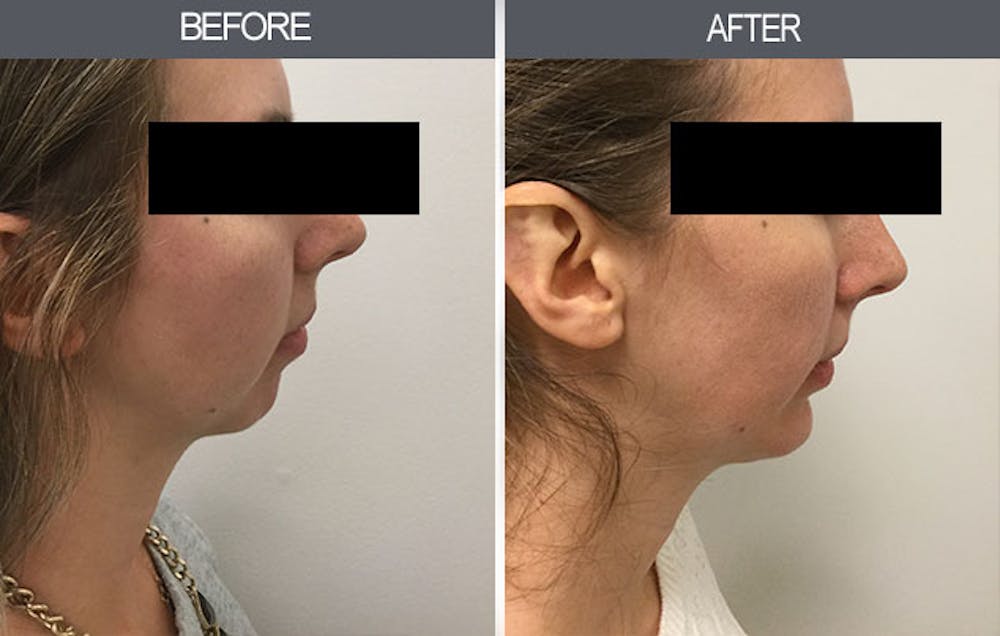 Chin Implants Before & After Gallery - Patient 4452268 - Image 3