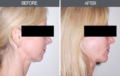 Chin Implants Before & After Gallery - Patient 4452269 - Image 2