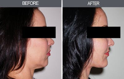Chin Implants Before & After Gallery - Patient 4452270 - Image 1