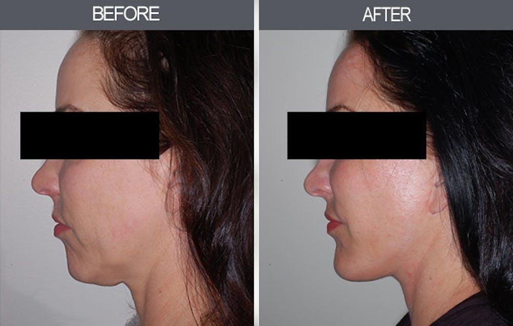 Chin Implants Before & After Gallery - Patient 4452270 - Image 2