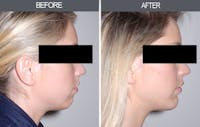 Chin Implants Gallery Before & After Gallery - Patient 4452271 - Image 1