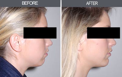 Chin Implants Before & After Gallery - Patient 4452271 - Image 1