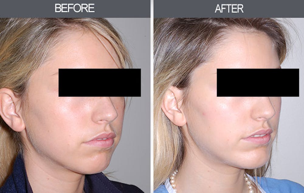 Chin Implants Before & After Gallery - Patient 4452271 - Image 2