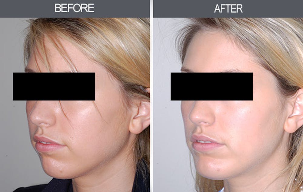 Chin Implants Gallery Before & After Gallery - Patient 4452271 - Image 3