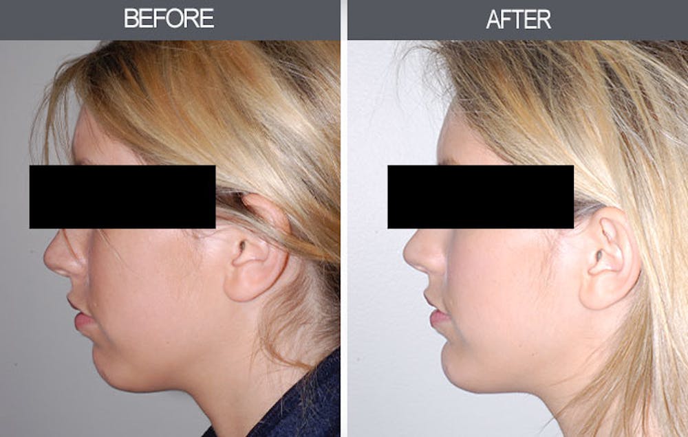 Chin Implants Before & After Gallery - Patient 4452271 - Image 4