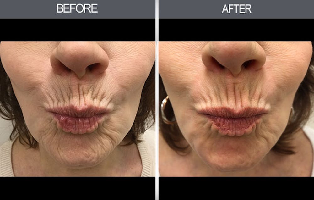 Chemical Peel Gallery Before & After Gallery - Patient 4452471 - Image 1