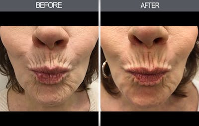 Chemical Peel Gallery Before & After Gallery - Patient 4452471 - Image 1