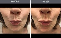 Chemical Peel Gallery Before & After Gallery - Patient 4452471 - Image 1