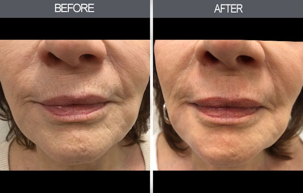 Chemical Peel Gallery Before & After Gallery - Patient 4452471 - Image 2