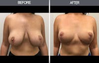 Breast Reduction Gallery Before & After Gallery - Patient 4452624 - Image 1
