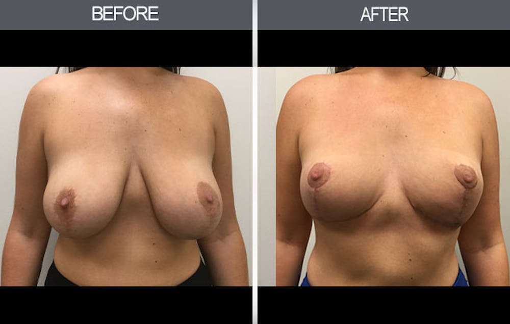Breast Reduction Before & After Gallery - Patient 4452624 - Image 1