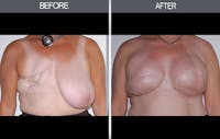 Breast Reconstruction Before & After Gallery - Patient 4452698 - Image 1
