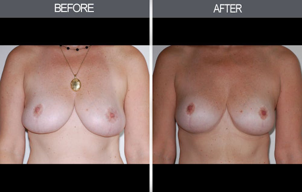 Breast Lift Gallery Before & After Gallery - Patient 4452820 - Image 1
