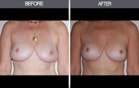 Breast Lift Gallery Before & After Gallery - Patient 4452820 - Image 1