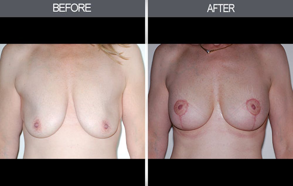 Breast Lift Gallery Before & After Gallery - Patient 4452821 - Image 1
