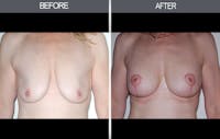 Breast Lift Gallery Before & After Gallery - Patient 4452821 - Image 1