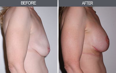 Breast Lift Before & After Gallery - Patient 4452821 - Image 2