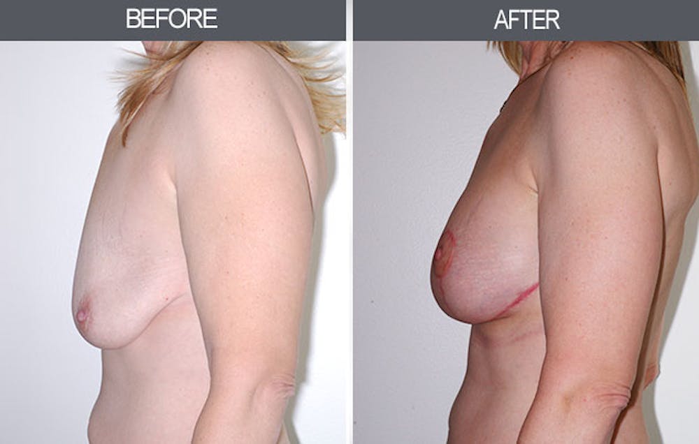 Breast Lift Before & After Gallery - Patient 4452821 - Image 3
