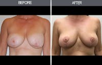 Breast Lift Before & After Gallery - Patient 4452822 - Image 1
