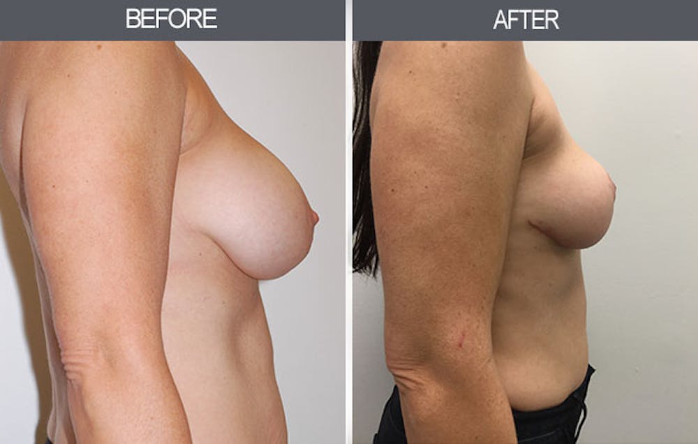 Breast Lift Gallery Before & After Gallery - Patient 4452822 - Image 2