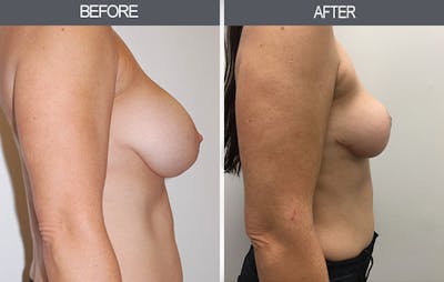 Breast Lift Before & After Gallery - Patient 4452822 - Image 2