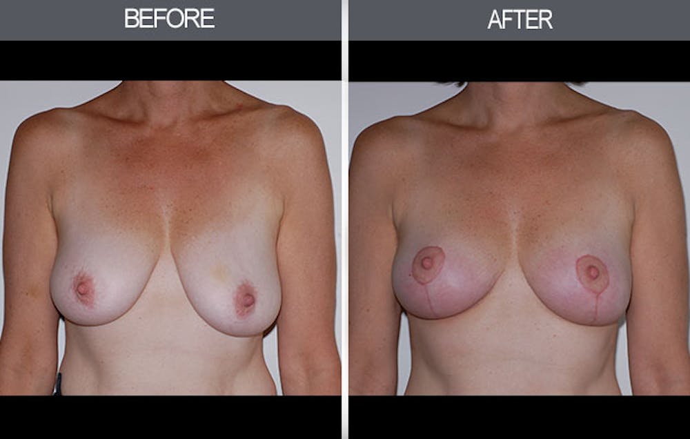 Breast Lift Gallery Before & After Gallery - Patient 4452823 - Image 1