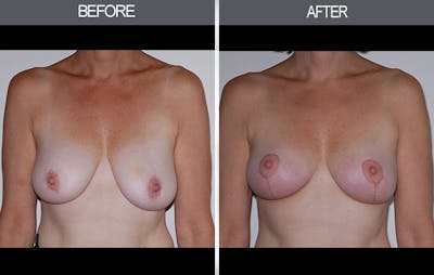 Breast Lift Gallery Before & After Gallery - Patient 4452823 - Image 1