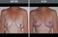 Breast Lift Before & After Gallery - Patient 4452823 - Image 1