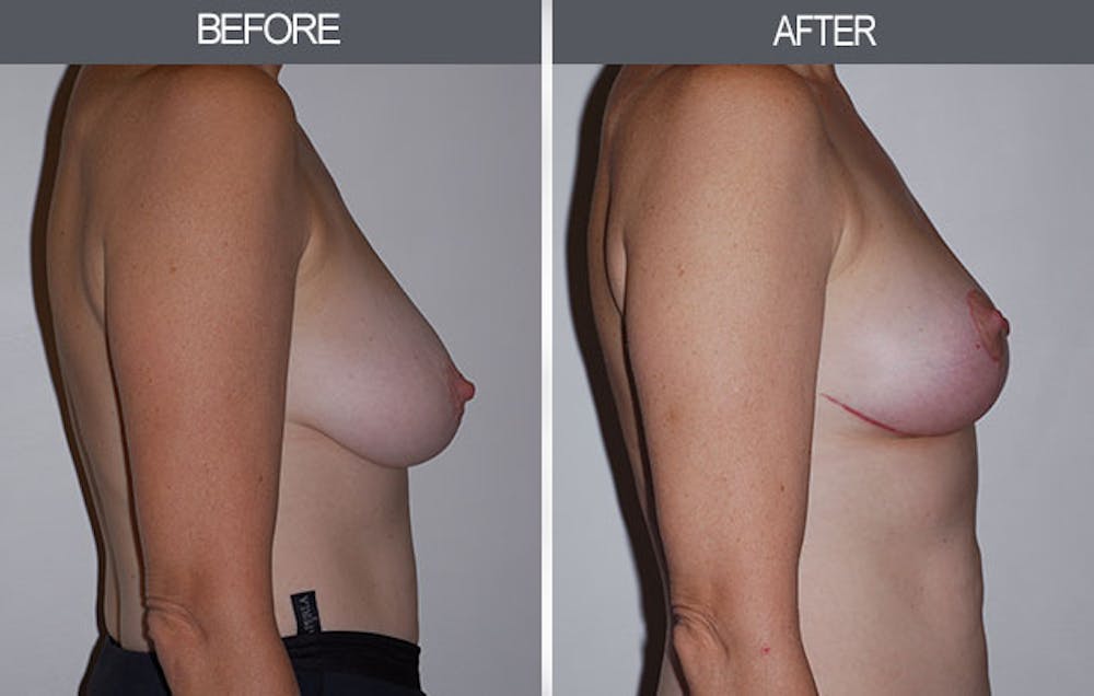 Breast Lift Before & After Gallery - Patient 4452823 - Image 2