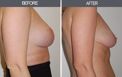 Breast Lift Before & After Gallery - Patient 4452824 - Image 1