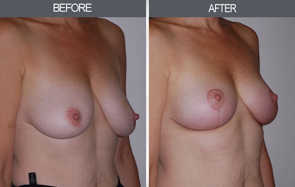 Breast Lift Gallery Before & After Gallery - Patient 4452823 - Image 3