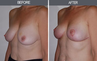 Breast Lift Gallery Before & After Gallery - Patient 4452823 - Image 4