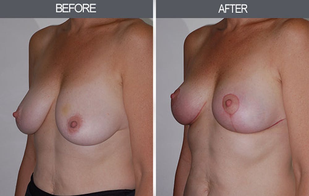 Breast Lift Before & After Gallery - Patient 4452823 - Image 4