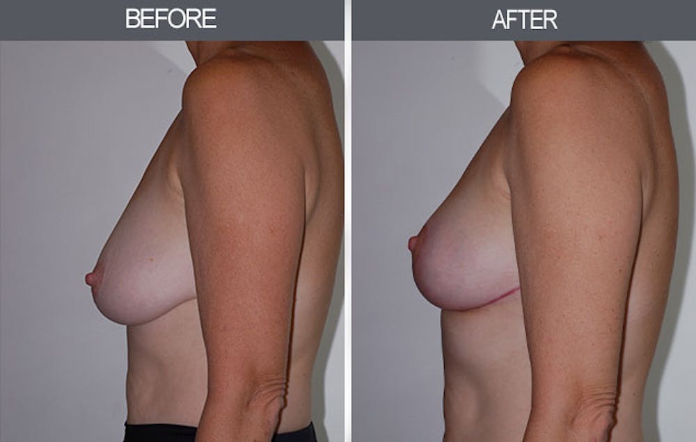 Breast Lift Before & After Gallery - Patient 4452823 - Image 5