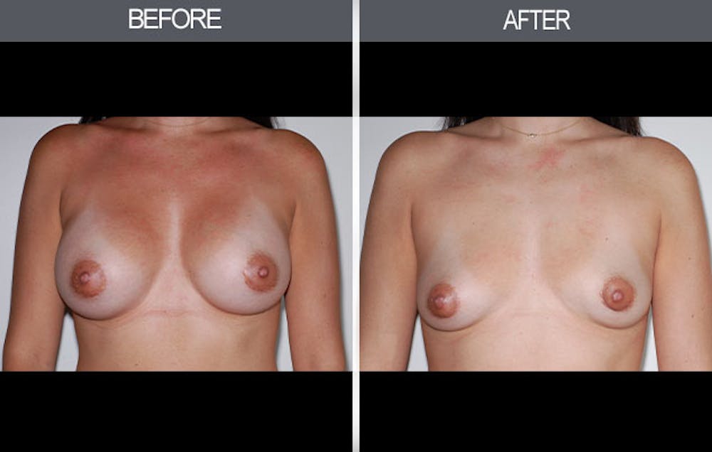 Breast Implant Removal Before & After Gallery - Patient 4452945 - Image 1