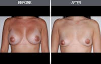 Breast Implant Removal Gallery Before & After Gallery - Patient 4452945 - Image 1