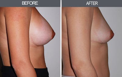 Breast Implant Removal Gallery Before & After Gallery - Patient 4452945 - Image 2