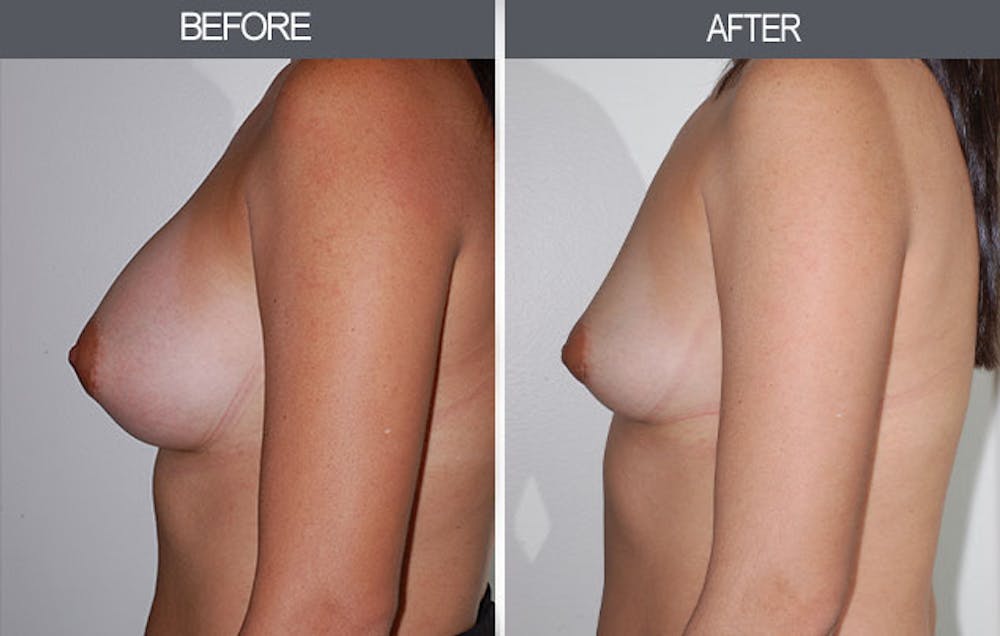 Breast Implant Removal Gallery Before & After Gallery - Patient 4452945 - Image 3