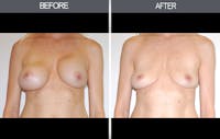 Breast Implant Removal Before & After Gallery - Patient 4452946 - Image 1