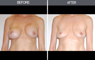 Breast Implant Removal Before & After Gallery - Patient 4452946 - Image 1