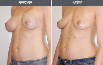 Breast Implant Removal Gallery Before & After Gallery - Patient 4452946 - Image 2