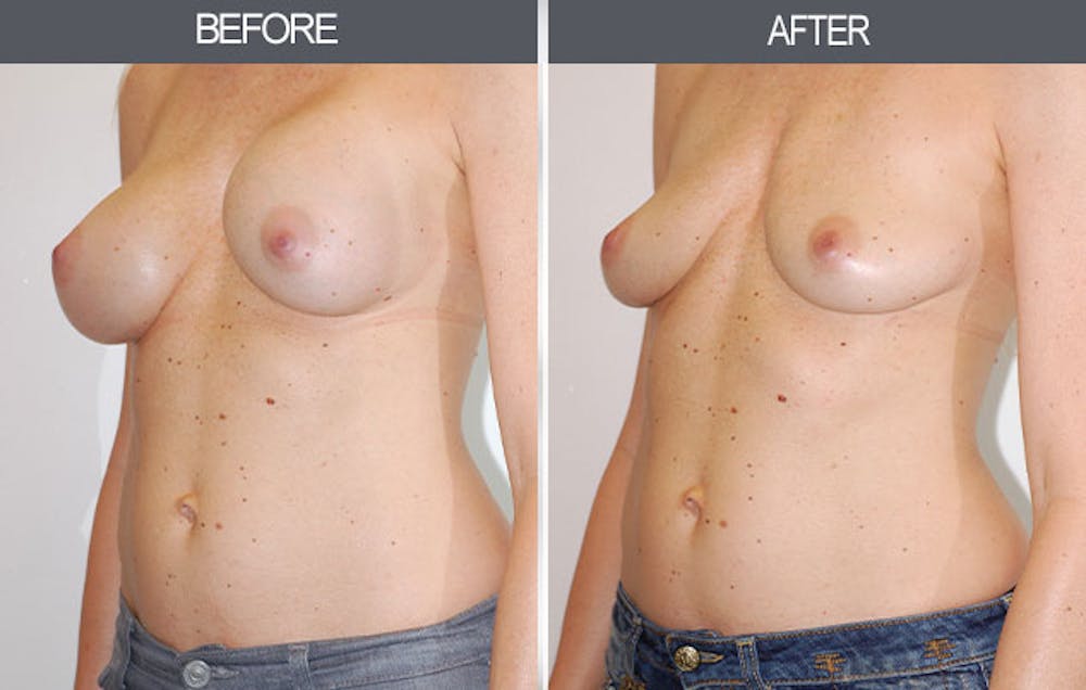 Breast Implant Removal Before & After Gallery - Patient 4452946 - Image 2