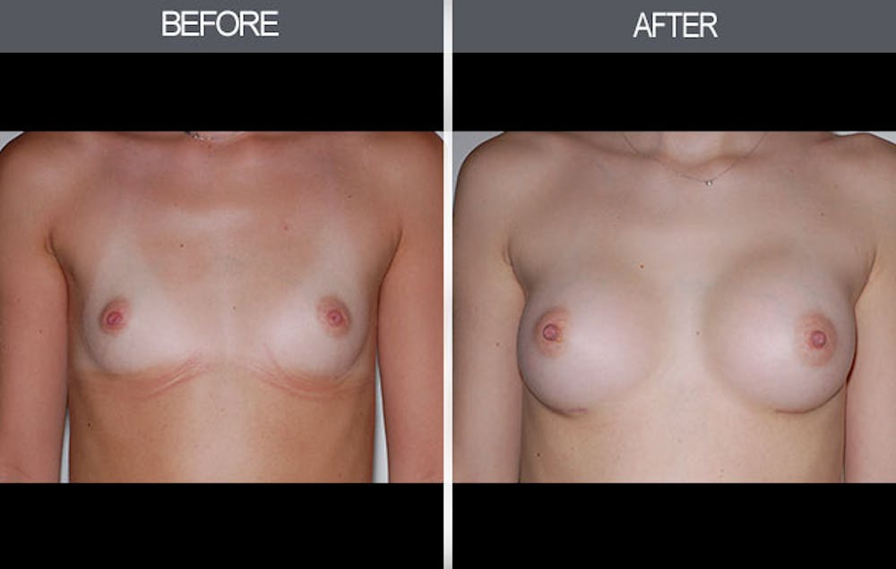 Breast Augmentation Gallery Before & After Gallery - Patient 4453064 - Image 1