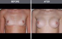 Breast Augmentation Gallery Before & After Gallery - Patient 4453064 - Image 1