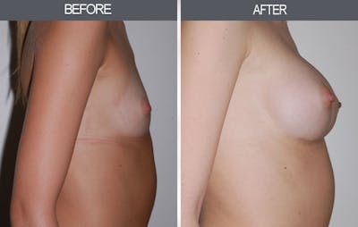 Breast Augmentation Before & After Gallery - Patient 4453064 - Image 2
