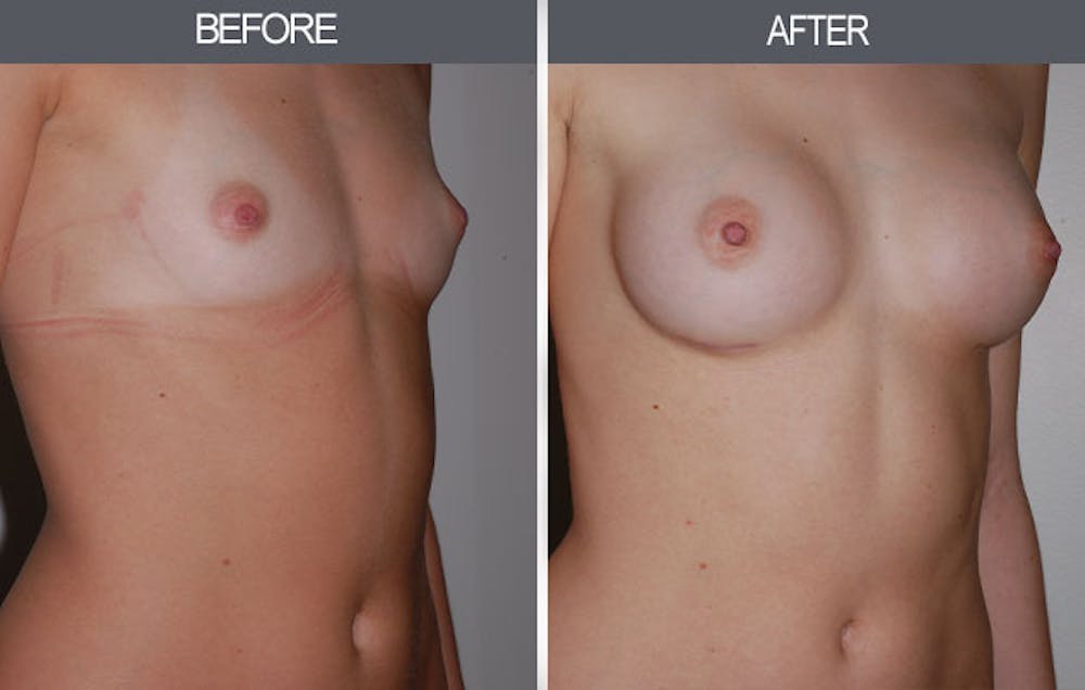 Breast Augmentation Gallery Before & After Gallery - Patient 4453064 - Image 3