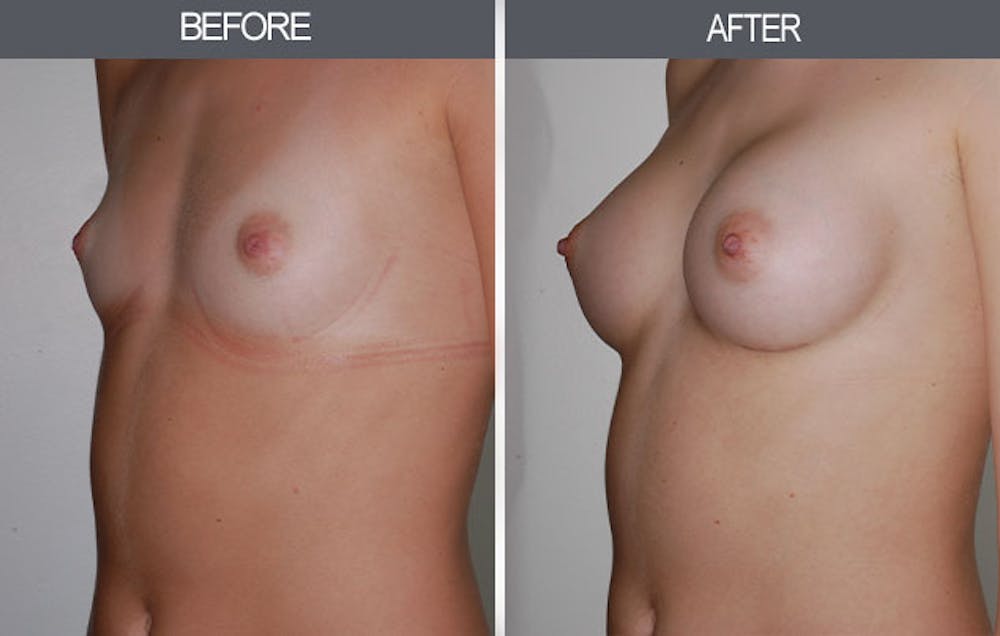 Breast Augmentation Gallery Before & After Gallery - Patient 4453064 - Image 4