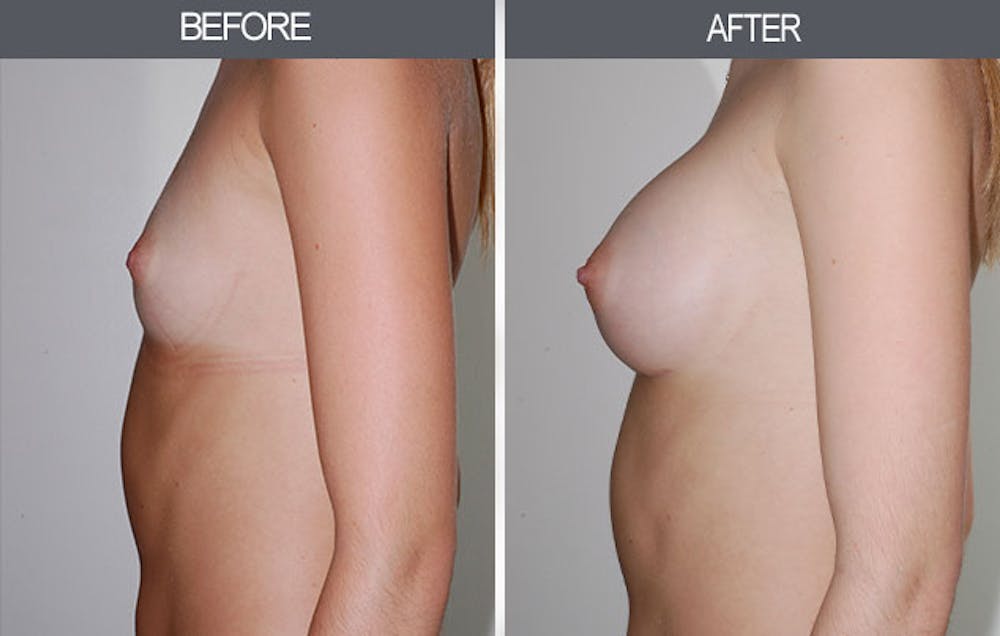 Breast Augmentation Gallery Before & After Gallery - Patient 4453064 - Image 5